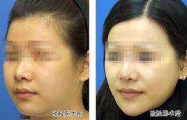 去下頜角 去下頜角