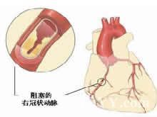 老年人急性心肌梗死