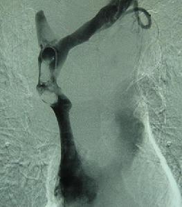 肝靜脈阻塞綜合徵