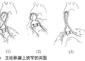 心肌梗塞並發心室間隔穿破