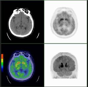 多巴胺D1受體顯像劑 多巴胺D1受體顯像劑