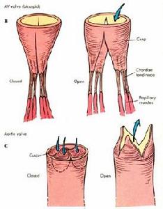 自體瓣膜心內膜炎