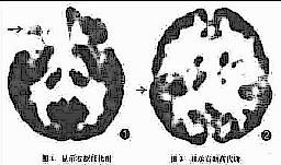 早期嬰兒型癲癇性腦病