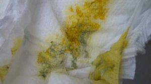 母乳性腹瀉 母乳性腹瀉