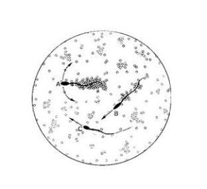 血清抗精子抗體陽性之不孕症 血清抗精子抗體陽性之不孕症