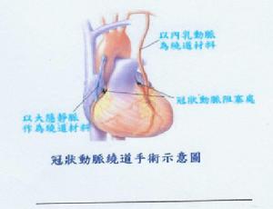 冠狀動脈繞道手術