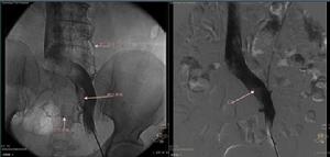 肝靜脈阻塞綜合徵