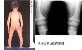 抗維生素D佝僂病 抗維生素D佝僂病