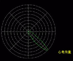 （圖）左束支中隔支傳導阻滯