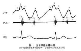 頸靜脈搏動圖 頸靜脈搏動圖