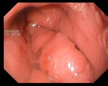 皮革胃電子胃鏡