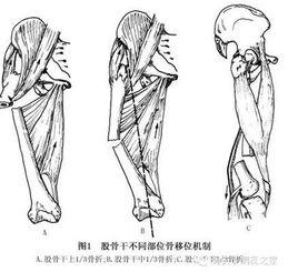 股骨幹骨折內固定術 股骨幹骨折內固定術