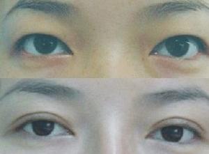 切開雙眼皮