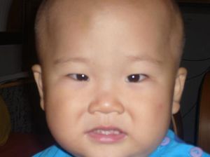 嬰幼兒型內斜視