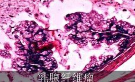 多發性乳腺纖維瘤 多發性乳腺纖維瘤