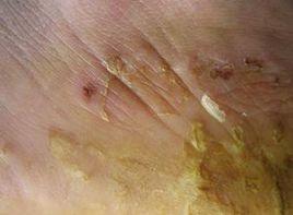 手足部厚壁水皰 手足部厚壁水皰