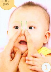 急性腺樣體炎 急性腺樣體炎