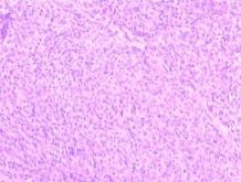 肛管直腸惡性黑色素瘤 肛管直腸惡性黑色素瘤