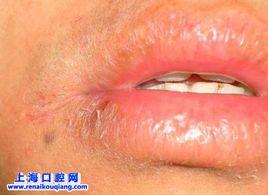 口腔乾燥綜合徵 口腔乾燥綜合徵