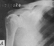 肱骨大結節囊性變