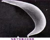 鐮狀細胞貧血 鐮狀細胞貧血