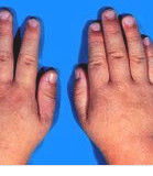 沙土皮炎 沙土皮炎