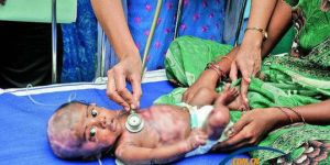 印度男嬰患“人體自燃症”