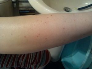 癢性紫癜 癢性紫癜