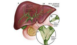 經皮肝穿膽道引流 經皮肝穿膽道引流