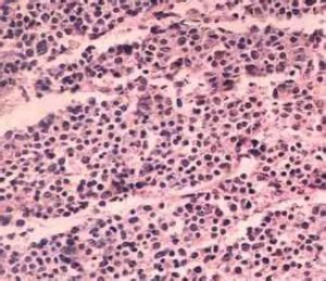 移行細胞癌 移行細胞癌