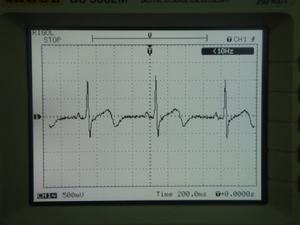 心房內傳導阻滯 心房內傳導阻滯