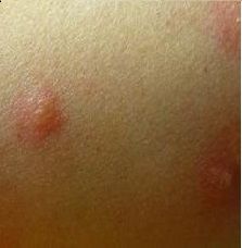 丘疹性蕁麻疹