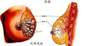 纖維囊性乳腺病 纖維囊性乳腺病