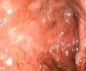 慢性潰瘍性結腸炎 慢性潰瘍性結腸炎