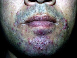 頜面部蜂窩織炎