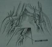 希恩綜合徵 希恩綜合徵
