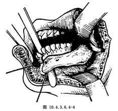 一側下頜骨切除術 一側下頜骨切除術
