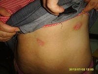 患者徐-紅皮型2-中國牛皮癬