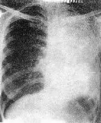 滑脫性肋骨綜合症 滑脫性肋骨綜合症