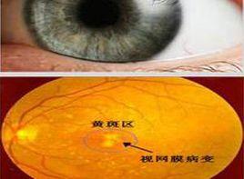 黃斑迴避現象 黃斑迴避現象