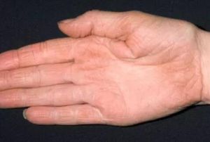 乾燥性皮炎 乾燥性皮炎