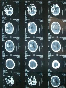 肌陣攣性小腦協調障礙