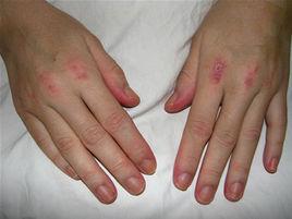 兒童皮肌炎 兒童皮肌炎