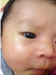 嬰兒痤瘡