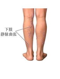 下肢靜脈曲張 下肢靜脈曲張