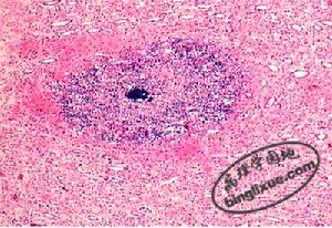 圖10 腎膿腫限局性腎組織壞死，中性粒細胞浸潤，中心有菌團