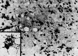 （圖）脂肪肉瘤