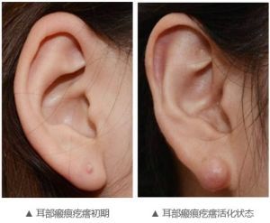 耳部瘢痕疙瘩