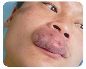 蔓狀血管瘤圖片