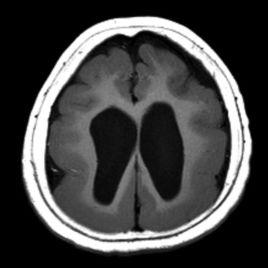 巨腦回畸形 巨腦回畸形